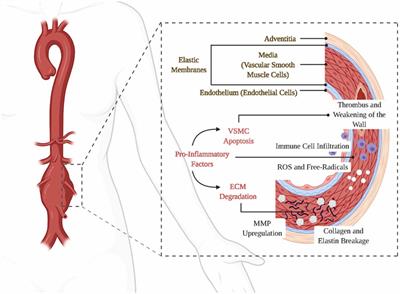 The future for the therapeutics of abdominal aortic aneurysm: engineered nanoparticles drug delivery for abdominal aortic aneurysm